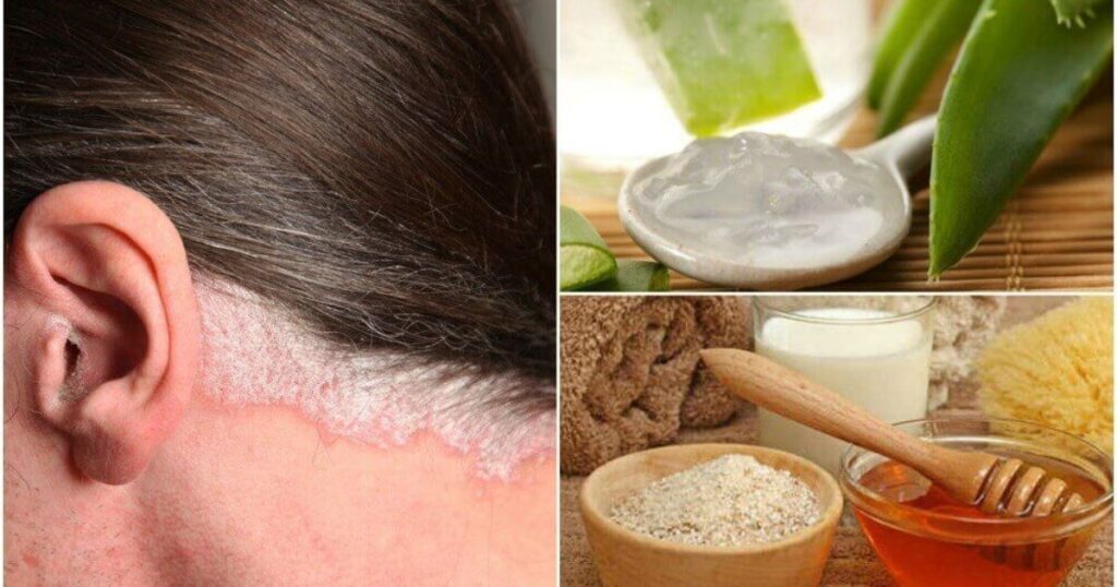 Natural Remedies To Prevent White Hair